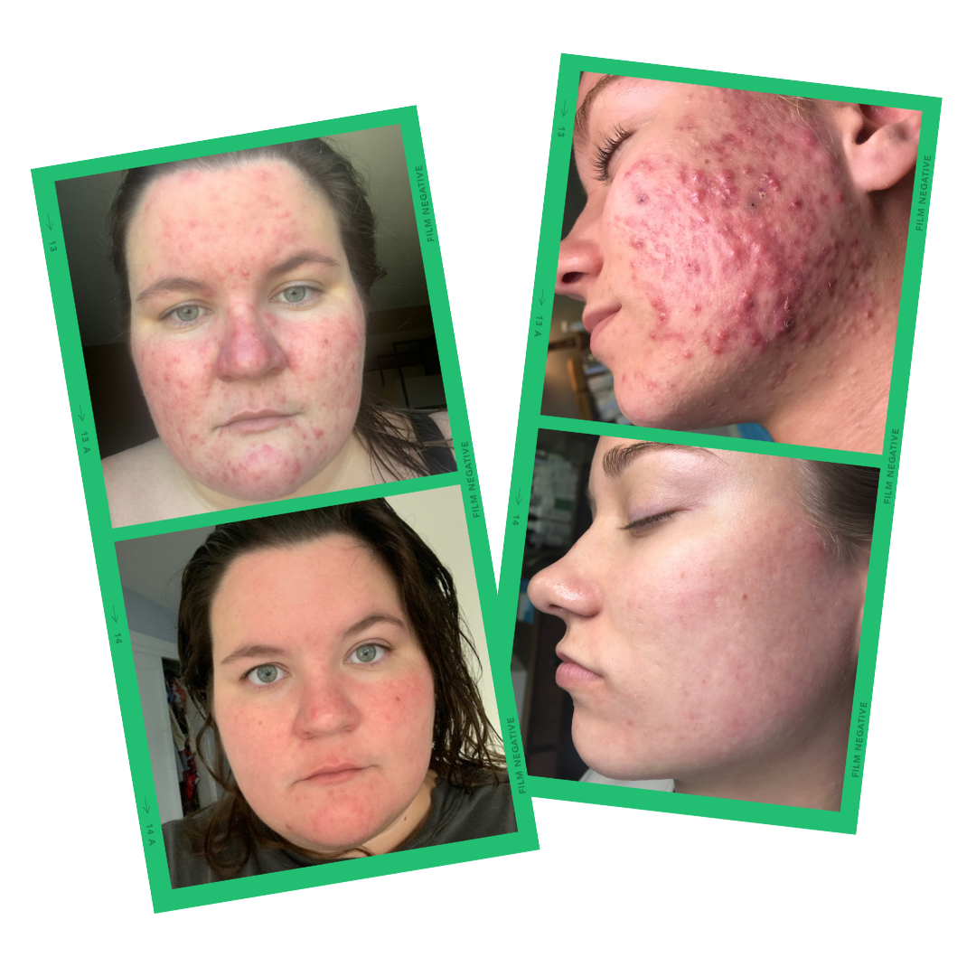 Acne Academy Kit
