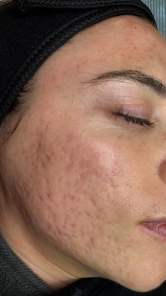 Botox vs. Dysport: Why We Chose Dysport at Skin+