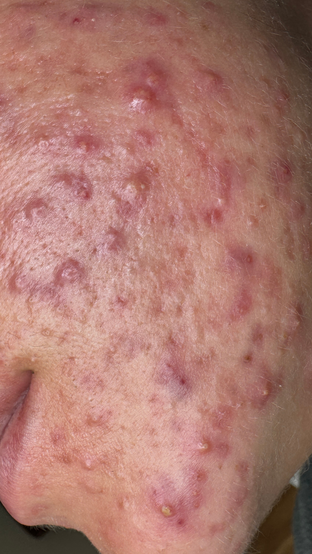 Picture of inflamed Acne