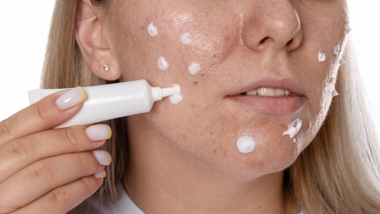 acne medicine on pimples