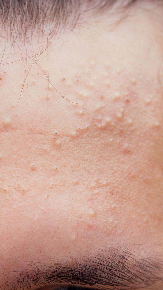 Non-Inflamed Acne: Clogged Pores + Treatment Tips