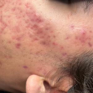 acne on face