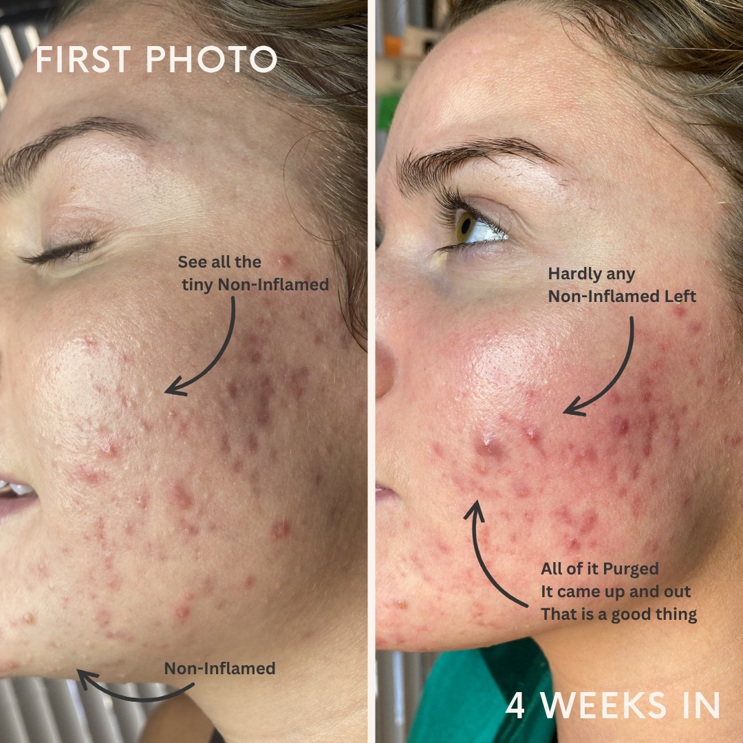 Skin Purging 4 weeks into Acne treatment