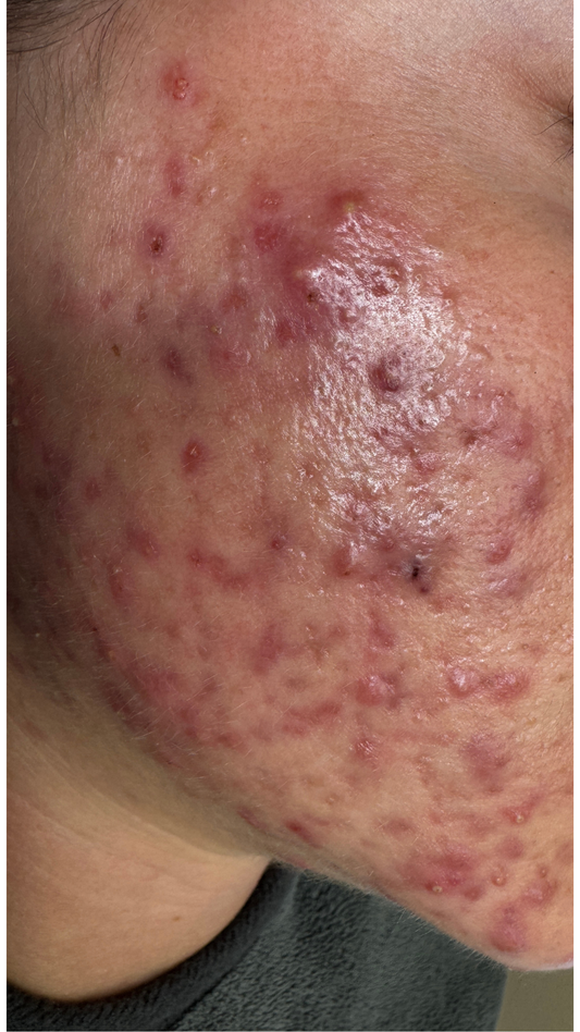 Can You Be Healthy and Still Have Severe Acne?