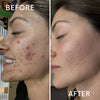 before after acne