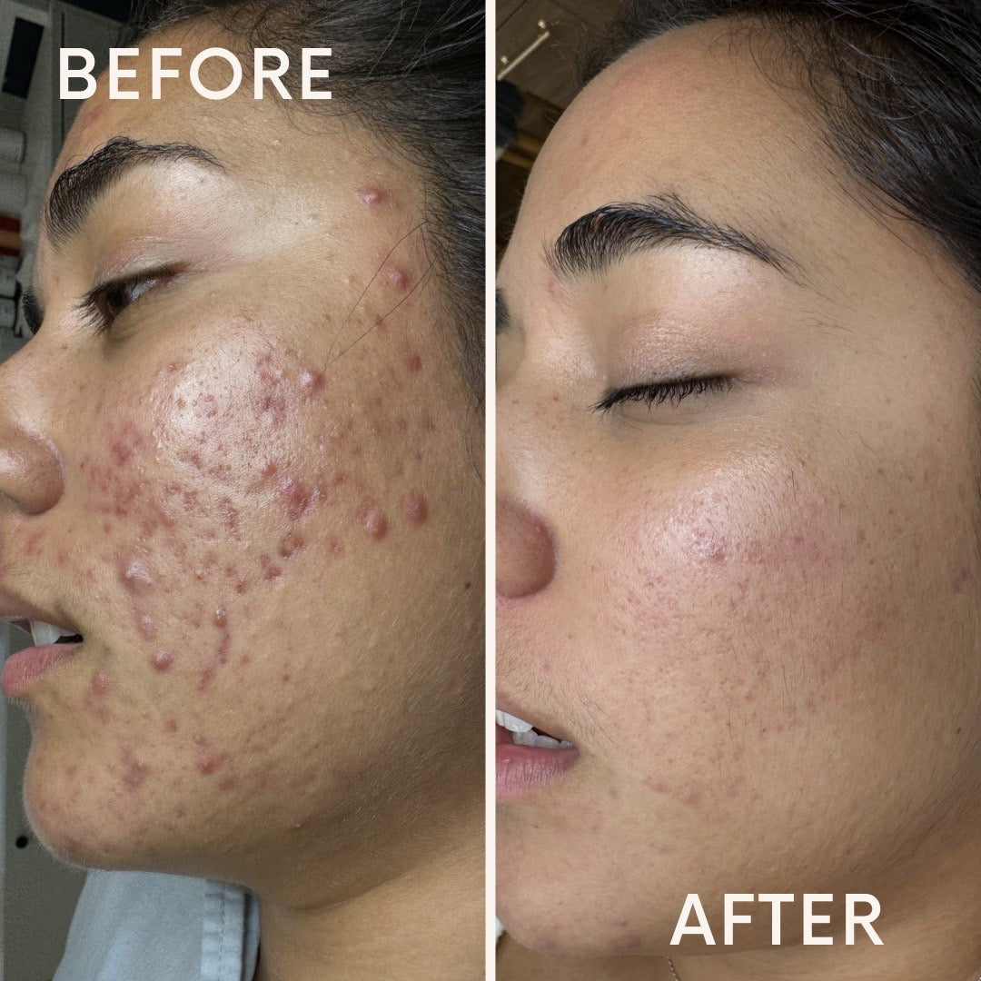 Skin Plus vs. Westlake Dermatology for Acne Treatment