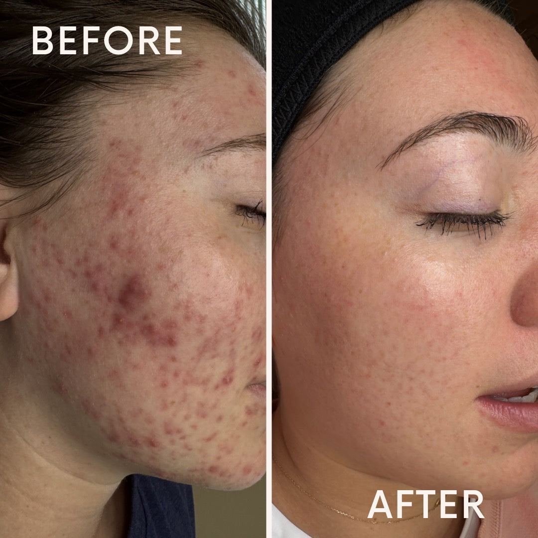 Acne Isn’t Cured, It’s Managed: What Clear Skin Really Takes