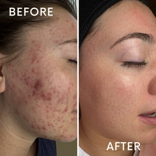 Acne Isn’t Cured, It’s Managed: What Clear Skin Really Takes