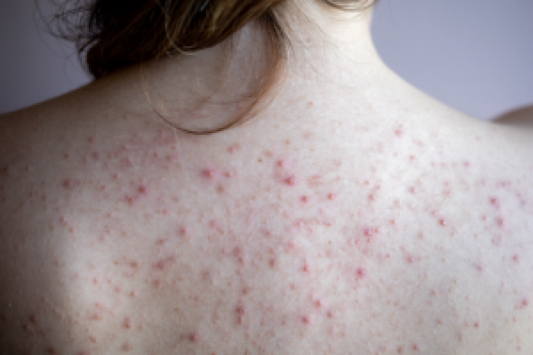 Body Acne, Folliculitis, or Keratosis Pilaris Guide