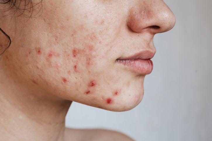 Adult Acne: Why Adults Still Get Pimples & How to Get Rid of It