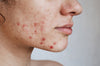 Adult Acne: Why Adults Still Get Pimples & How to Get Rid of It