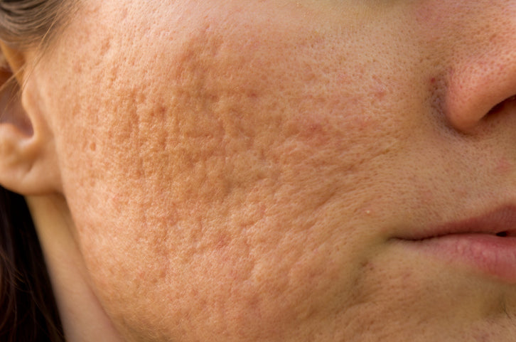 Acne Scars vs. Post-Inflammatory Hyperpigmentation