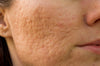 Acne Scars vs. Post-Inflammatory Hyperpigmentation
