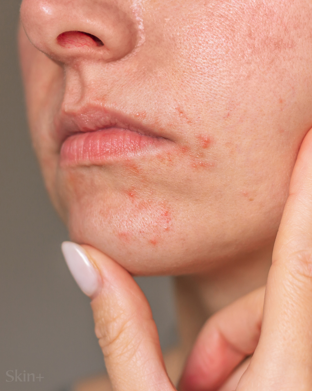girl with acne around mouth