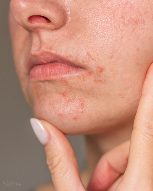 Perioral Dermatitis vs Acne Around Mouth: How to Tell