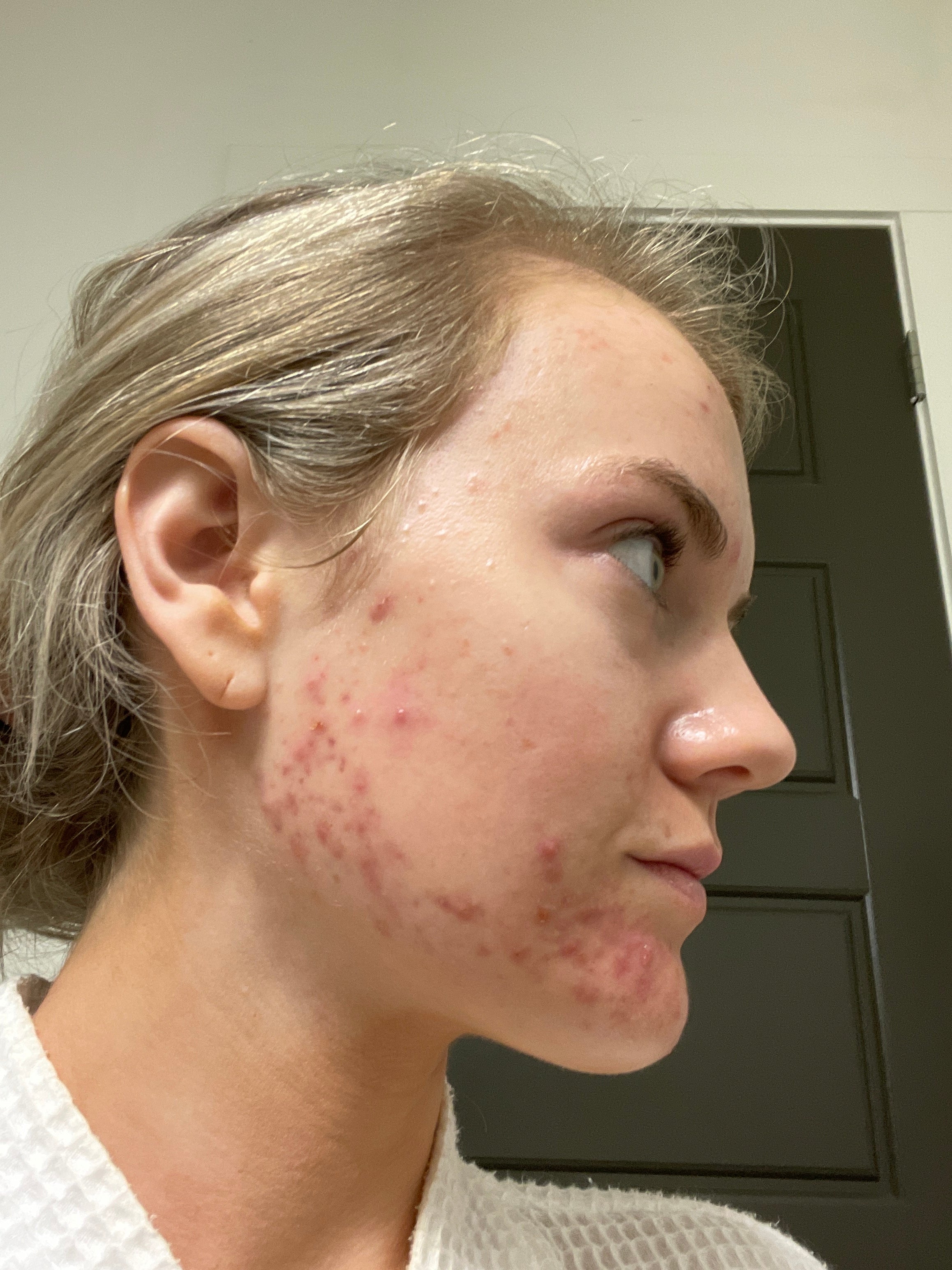 Intensive Acne Care – Skin+