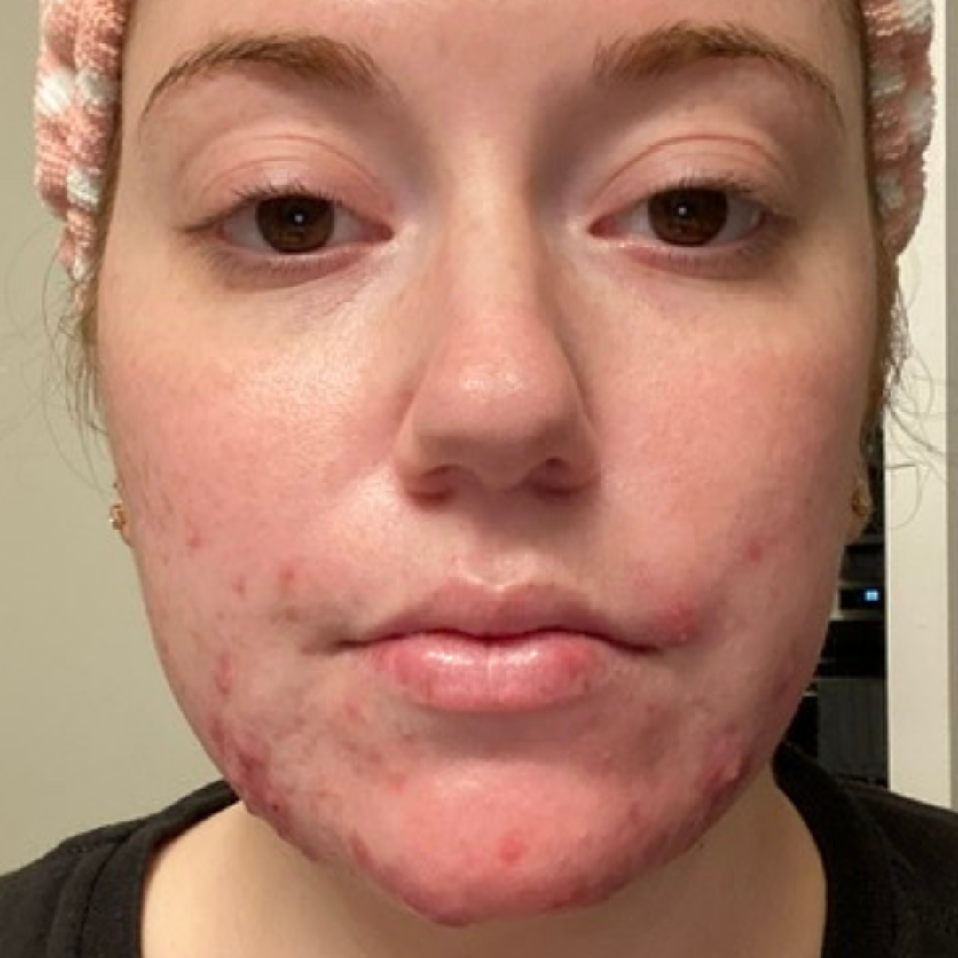 Skinplus Skin Plus Clinical Skincare | Science-Driven Acne Solutions – Skin+